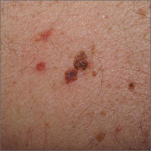 Back lesion