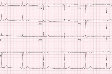 Sinus bradycardia EKG