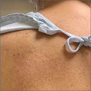 Rash on back
