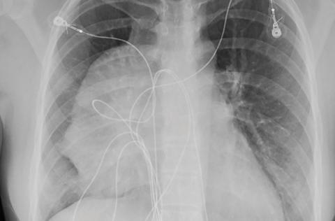 Large mass in the mediastinum