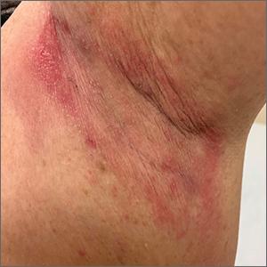 Erythematous axillary plaques