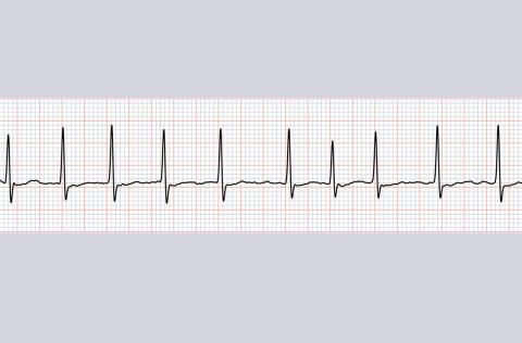 A-fib