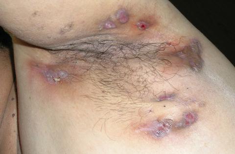 The 30-year-old patient had multiple inflammatory lesions of the axilla