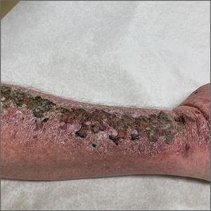 Arm rash