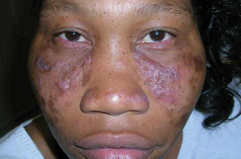 Multicolored (pink, brown, and white) indurated plaques in a butterfly distribution on the face of a 30-year-old woman with a darker skin tone