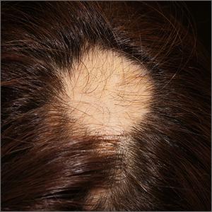 Focal hair loss