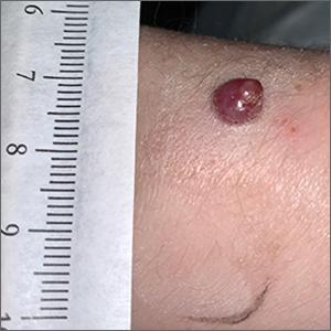 Bleeding arm lesion