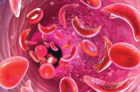 Sickle cell
