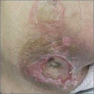 Sacral blistering