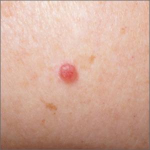 Pink shoulder lesion