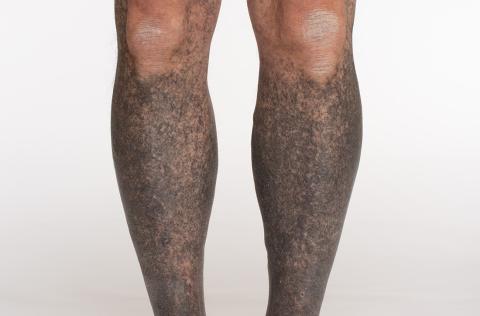Confluent blue-black hyperpigmentation of the legs