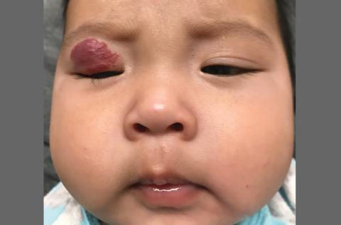 As this 4-month-old infant grew, so did the lesion