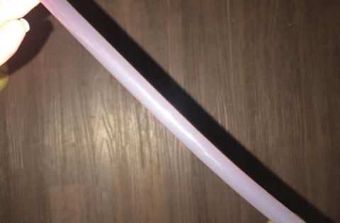 Purple urine was visible in the catheter and collection bag