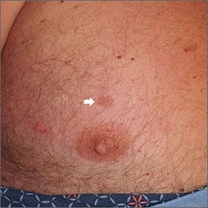 Chest lesion 