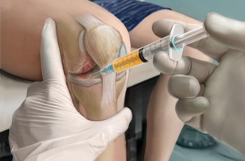 Platelet-rich plasma
