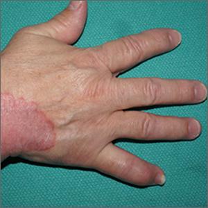Focal plaques and finger swelling
