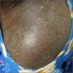 Xerosis and scaling with widespread excoriations