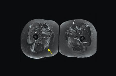 MRI of the patient’s thighs pointed to the Dx