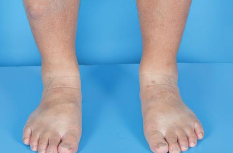 Painless nodules on legs