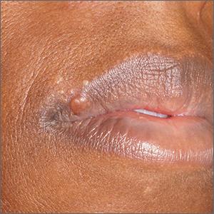 Papules on lip