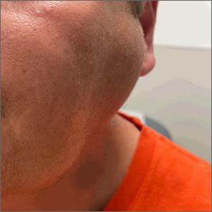 Bilateral facial swelling 
