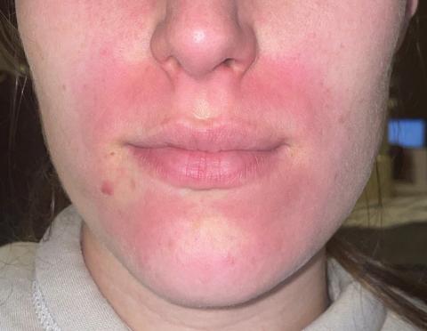 Erythema