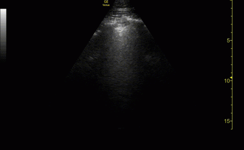 PHASE ARRAY PROBE, ANTERIOR LUNG FIELD, IRREGULAR PLEURA