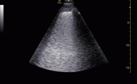 PHASED ARRAY PROBE, ANTERIOR LUNG FIELD, IRREGULAR PLEURA WITH CONFLUENT B LINES