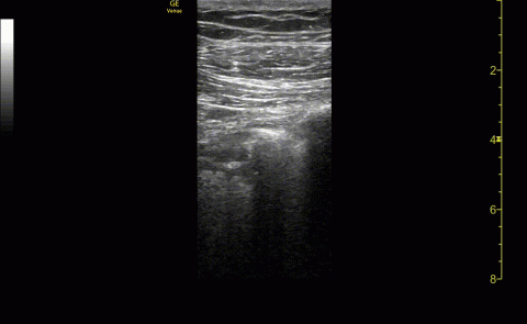 CLIP/IMAGE 3: LINEAR PROBE, ANTERIOR LUNG FIELD, IRREGULAR PLEURA WITH SUBPLEURAL CONSOLIDATION