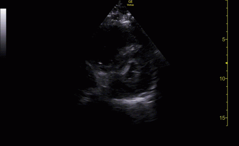 CLIP/IMAGE 5- PHASED ARRAY PROBE, PARASTERNAL SHORT AXIS CARDIAC VIEW, Right Ventricle pressure and volume overload 