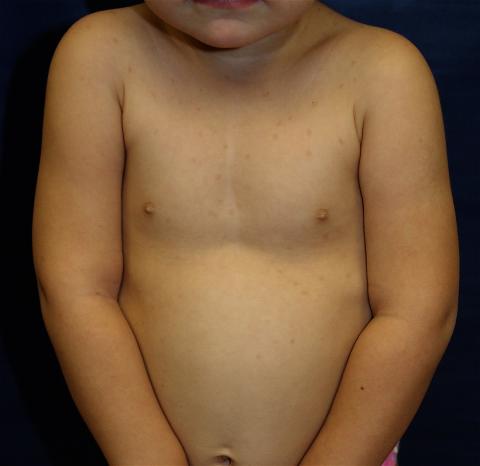 Physical exam was notable for many scattered, 3 to 5 mm, polymorphic, light brown to orange macules and papules.