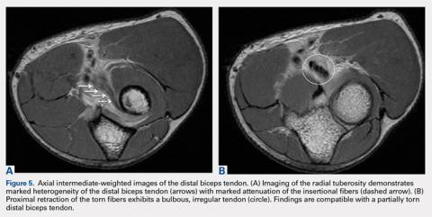 Magnetic Resonance Imaging Evaluation of the Distal Biceps Tendon ...