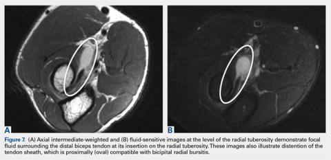 Magnetic Resonance Imaging Evaluation of the Distal Biceps Tendon ...