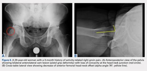 A Three-View Radiographic Approach to Femoroacetabular Impingement ...