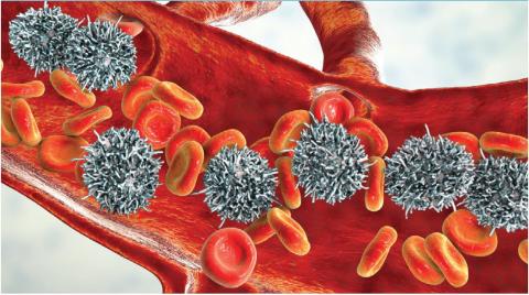 Figure 1. Typical Appearance of Hairy Cell Leukemia
