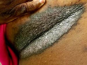 Rash