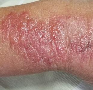 Poison ivy on arm