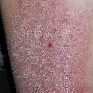 Rash on right leg