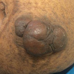 Cutaneous Insulin-Derived Amyloidosis Presenting as Hyperkeratotic Nodules