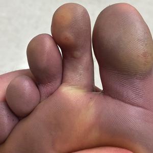 Pernio that first occurred years prior in a soldier who spent 2 days at a shooting range in the snow while stationed in Germany. The skin on the toes was mildly cyanotic and there were scattered bullae.