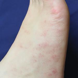 Numerous scattered, faint, erythematous, blanchable macules on the right foot.