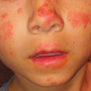 Pruritic photosensitive rash