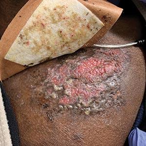 Ulcerated and verrucous plaque on the chest 