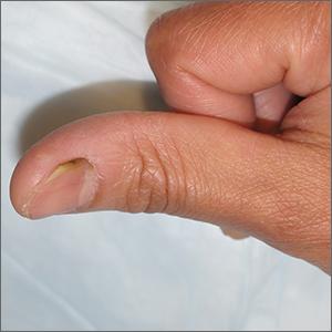 Green discoloration of the nail