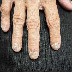 Nail dystrophy 