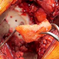 Glenoid Bone Loss in Reverse Shoulder Arthroplasty Treated with Bone Graft Techniques