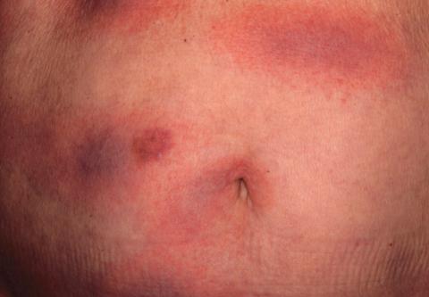Multifocal Annular Pink Plaques With a Central Violaceous Hue 
