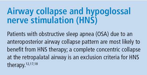 Airway collapse and hypoglossal nerve stimulation (HNS)