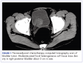 Paraneoplastic leukemoid reaction – poor prognostic marker in urothelial bladder carcinoma