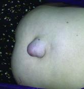 Follow-up data support using mesh for umbilical hernia repair
